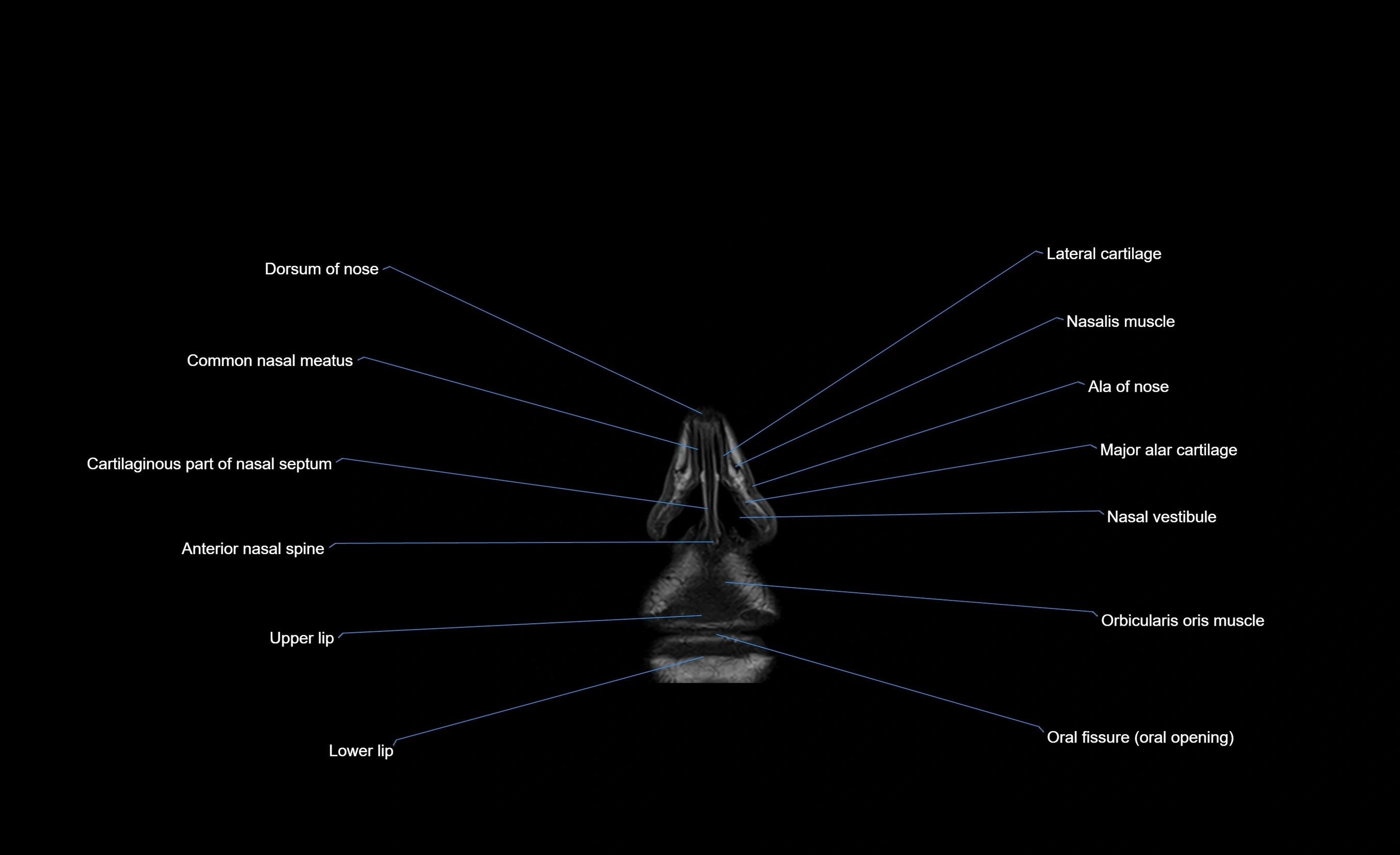 MRI face & paranasal sinuses(PNS) labelled  coronal  cross sectional anatomy 3T radiology  image-img-00001-00006.webp